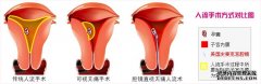 鸡西宫腔镜取胚术人流过程清晰可视 安全保宫